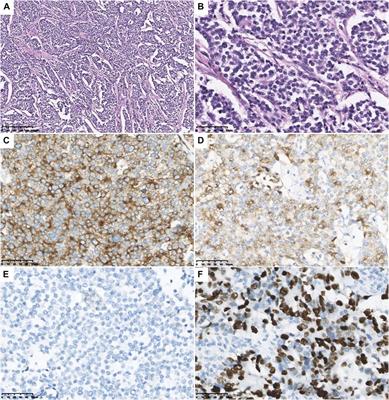 A Rare Heterozygous TINF2 Deletional Frameshift Mutation in a Chinese Pedigree With a Spectrum of TBDs Phenotypes